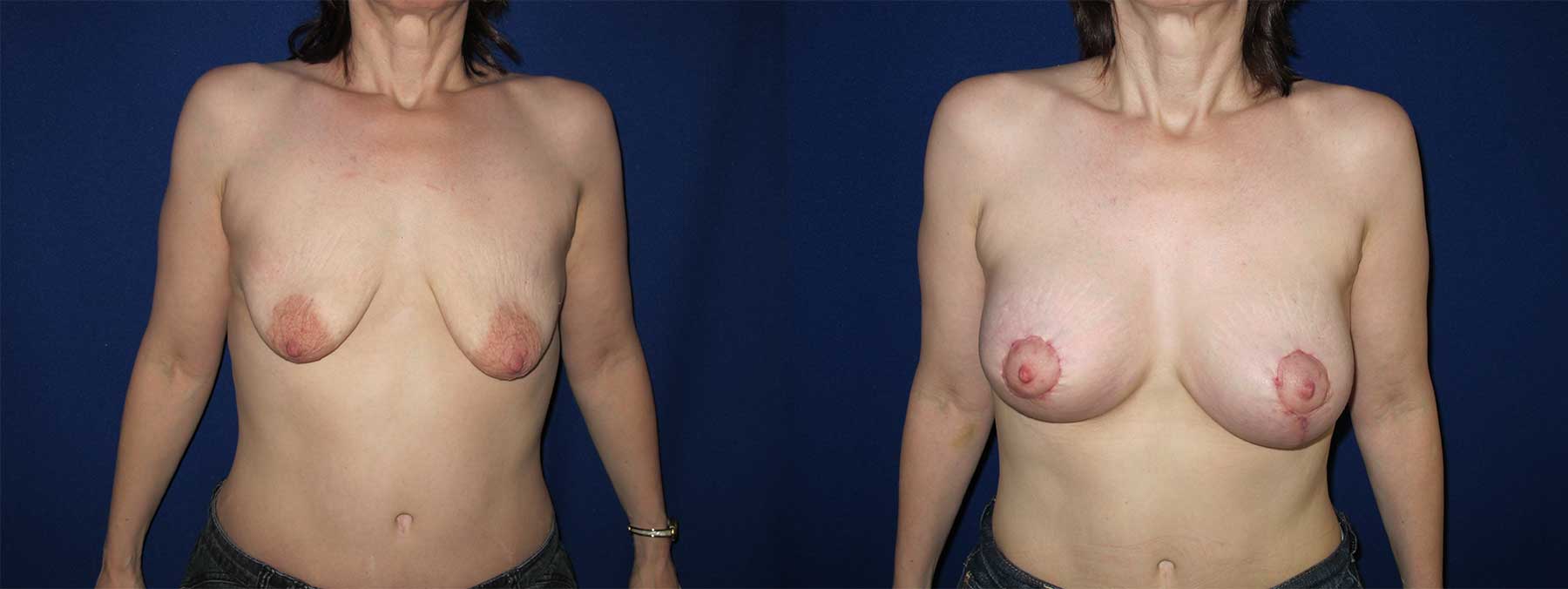 Before and After Image of Augmentation Mastoplexy