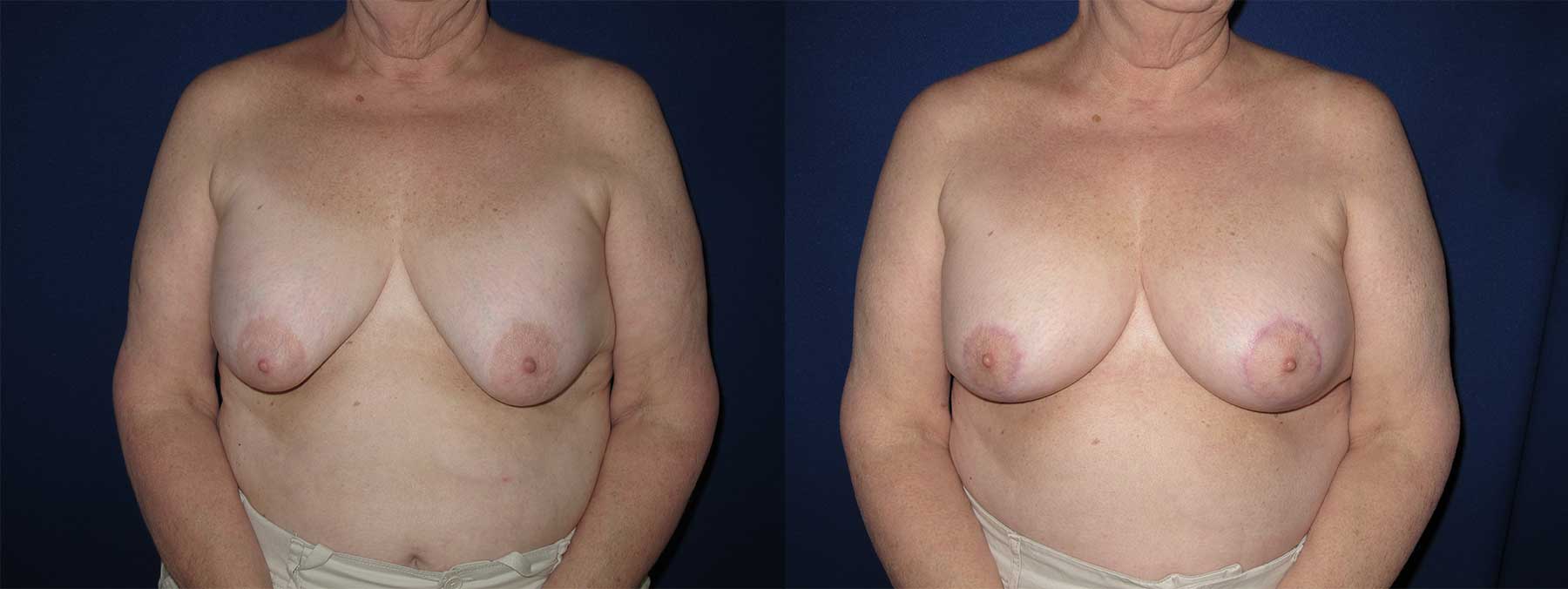 Before and After Image of Augmentation Mastoplexy