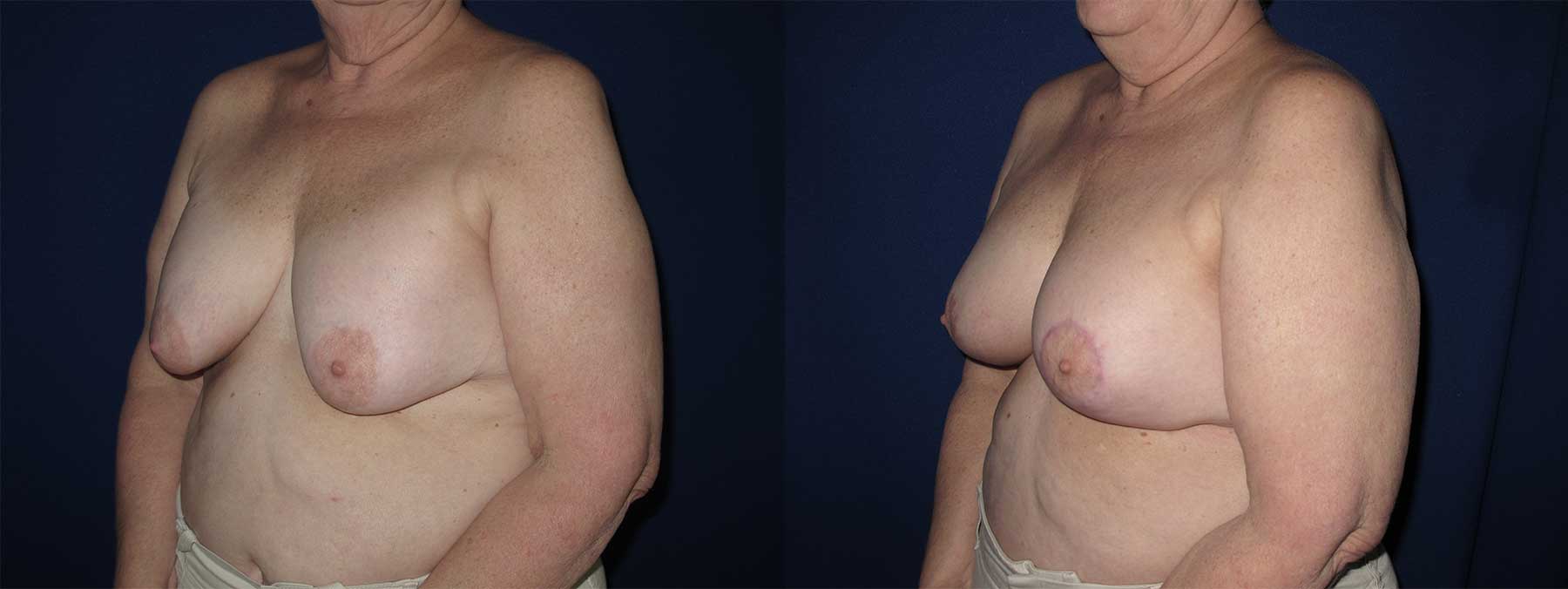 Before and After Image of Augmentation Mastoplexy