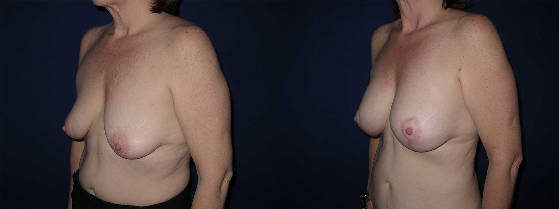 Before and After Image of Augmentation Mastoplexy