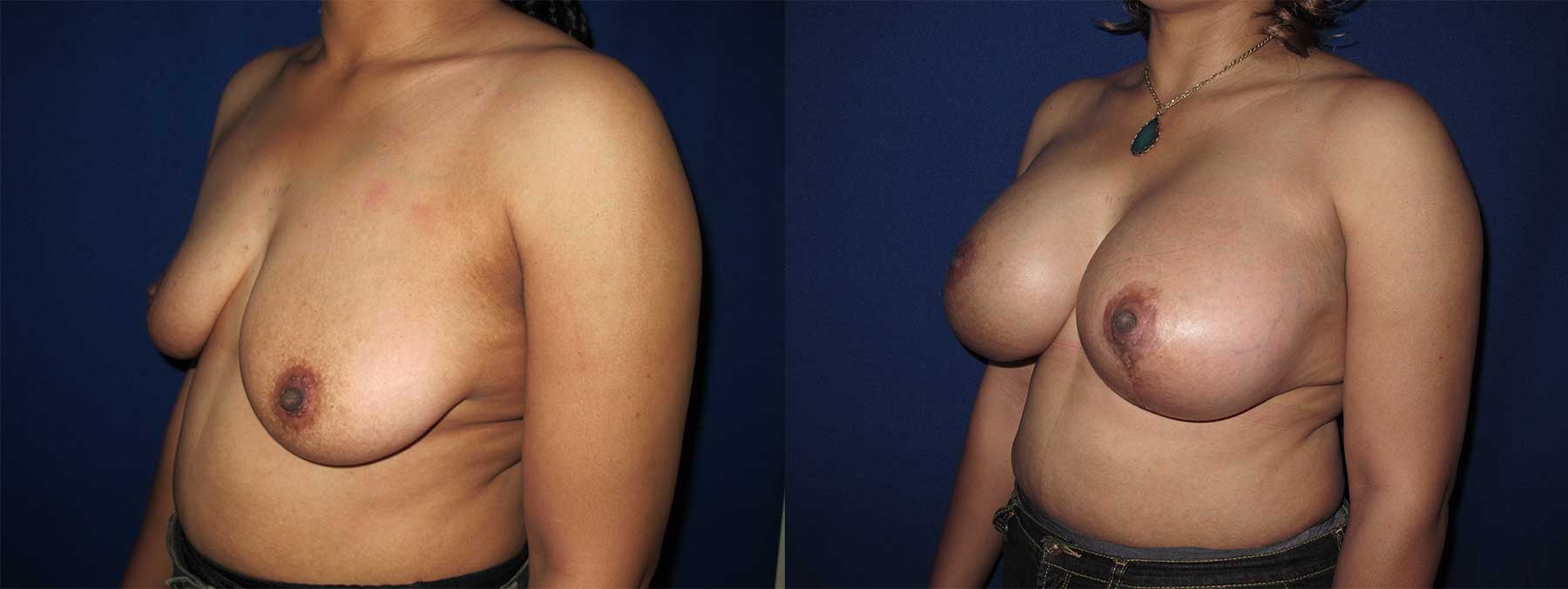 Before and After Image of Augmentation Mastoplexy