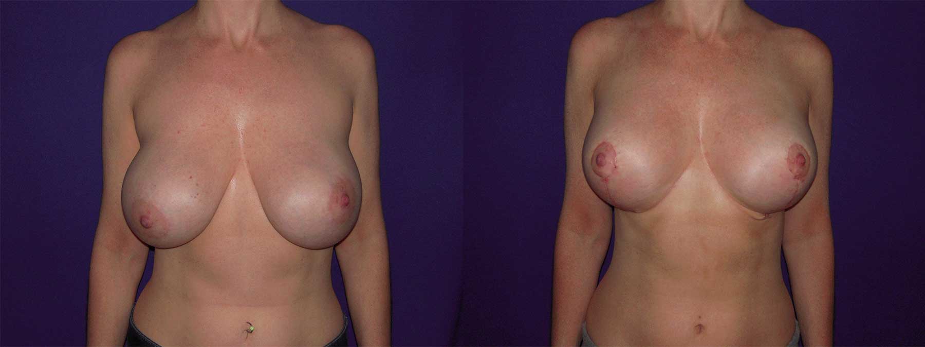 Before and After Image of Augmentation Mastoplexy