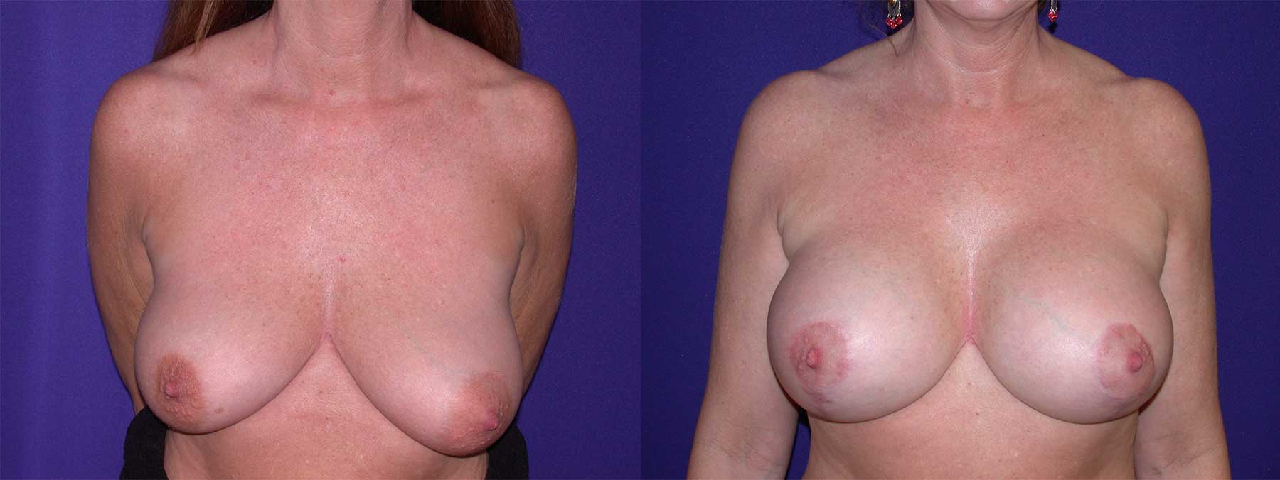 Before and After Image of Augmentation Mastoplexy