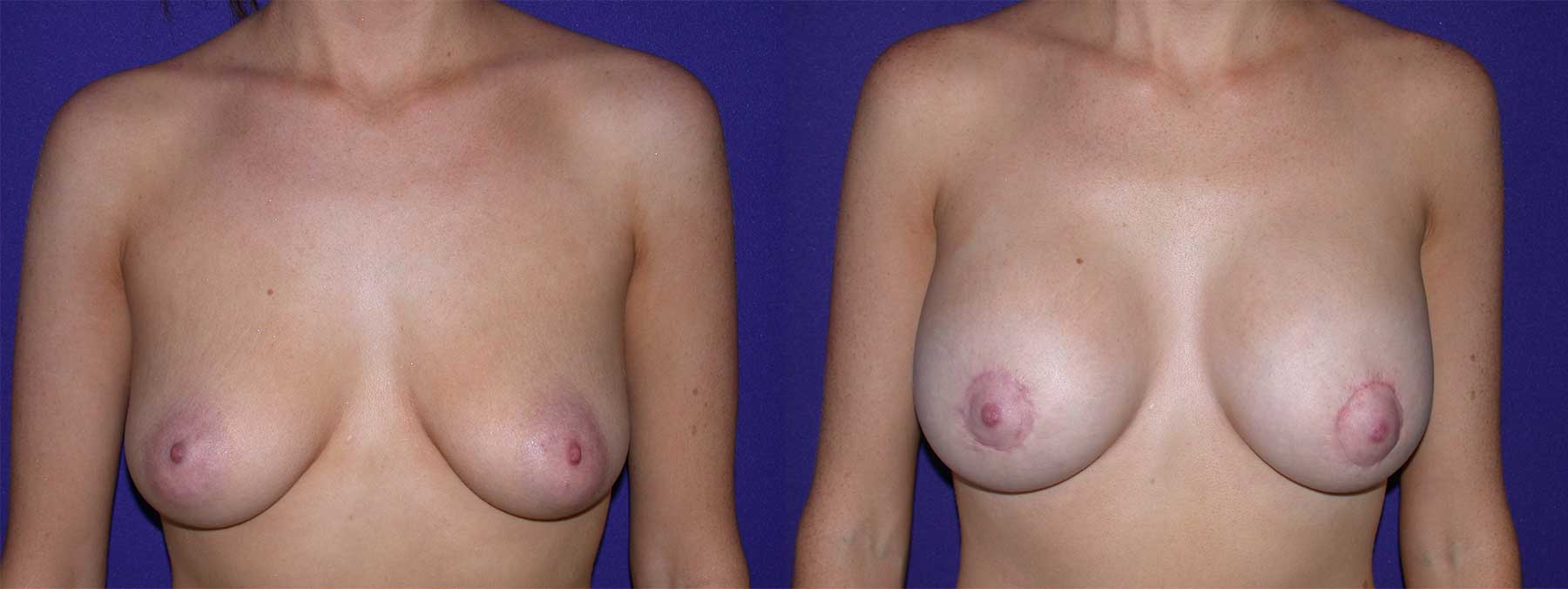 Before and After Image of Augmentation Mastoplexy