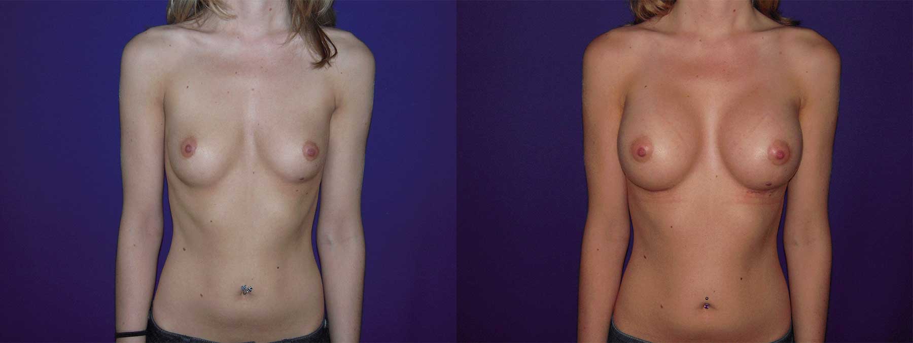 Before and After Image of Augmentation Mammoplasty