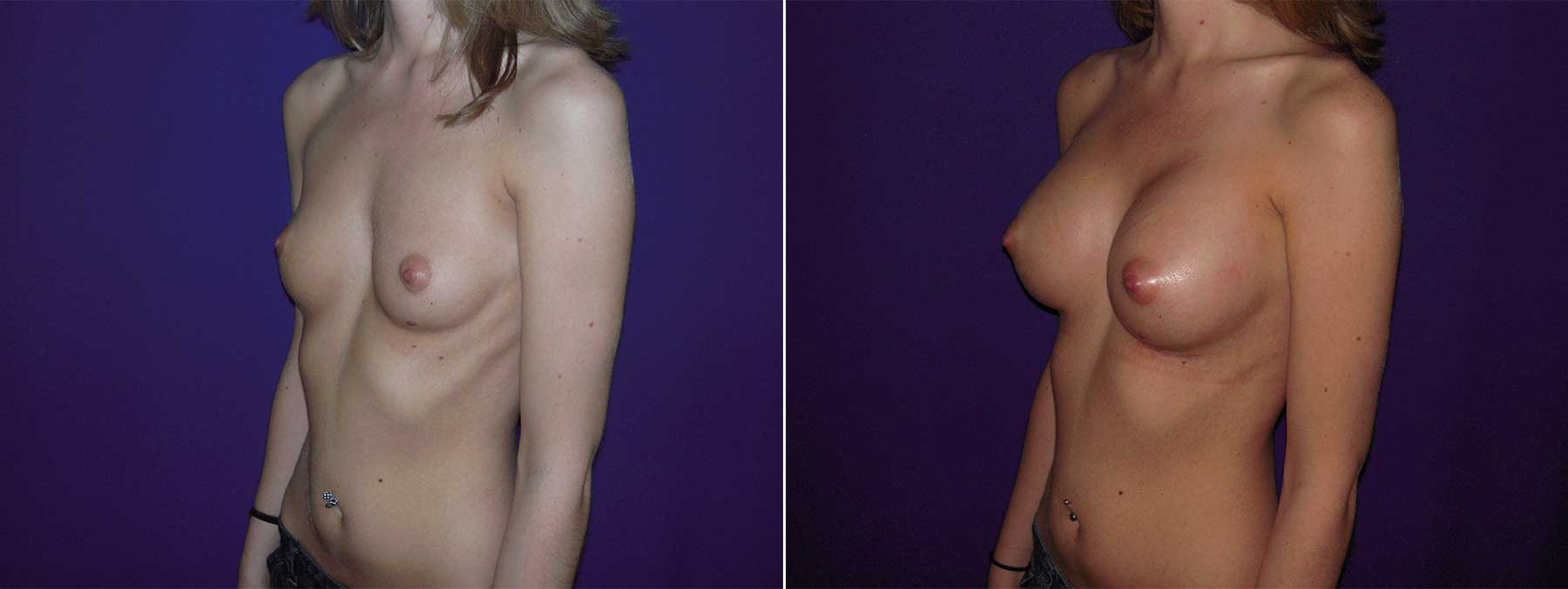 Before and After Image of Augmentation Mammoplasty