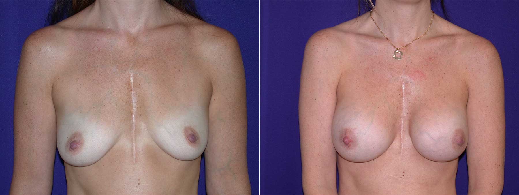 Before and After Image of Augmentation Mammoplasty