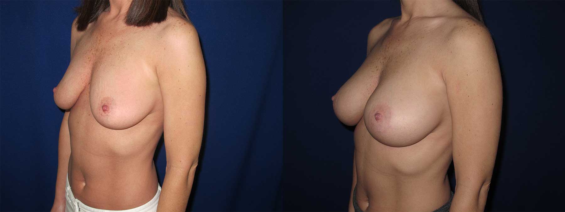 Before and After Image of Augmentation Mammoplasty