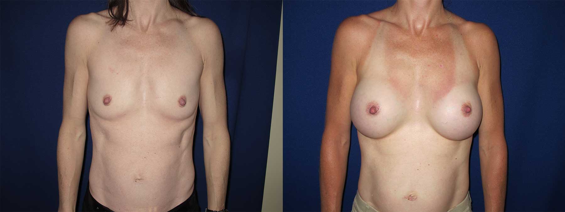 Before and After Image of Augmentation Mammoplasty