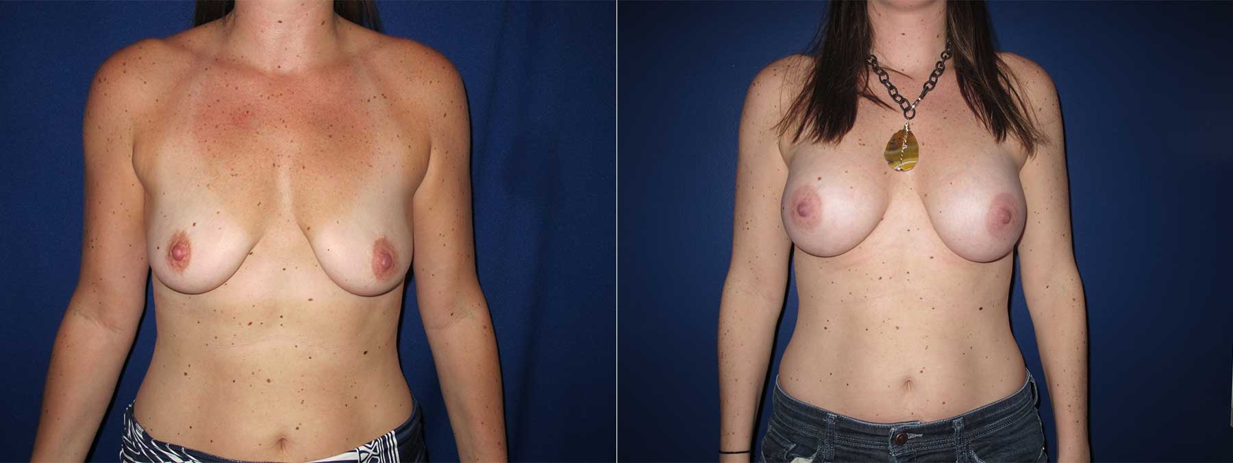 Before and After Image of Augmentation Mammoplasty