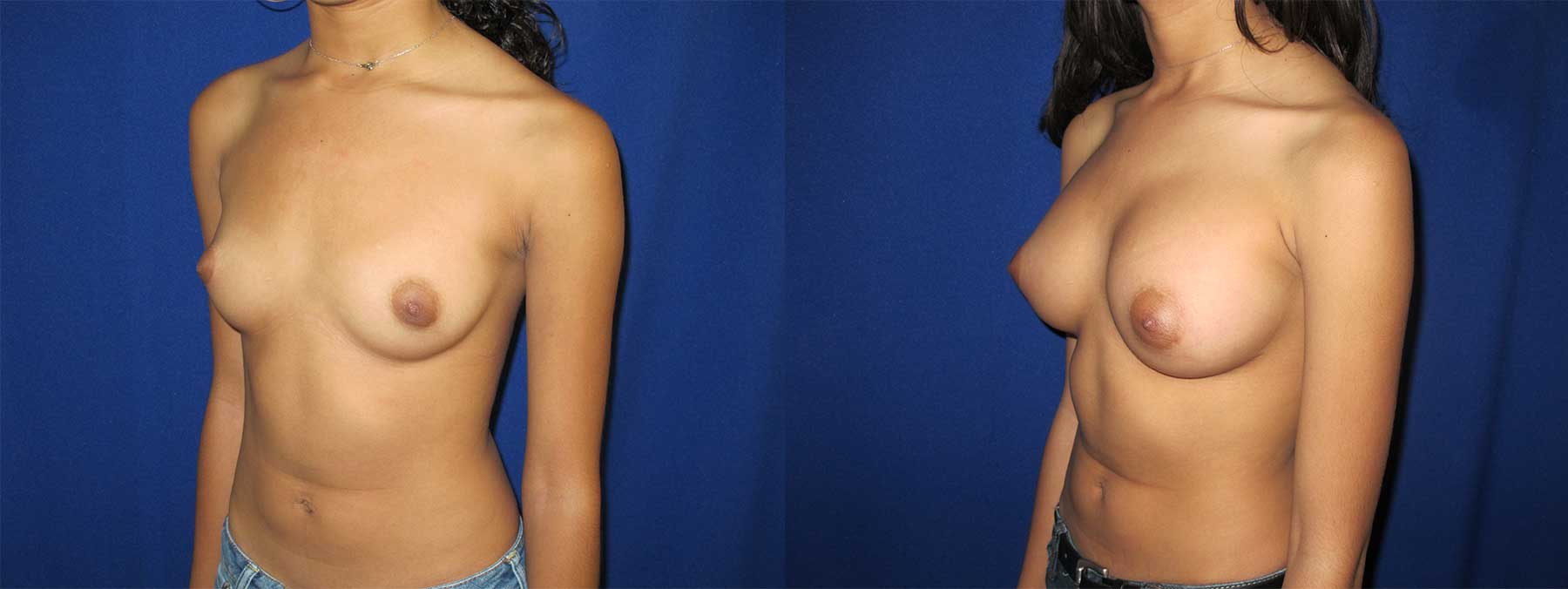 Before and After Image of Augmentation Mammoplasty