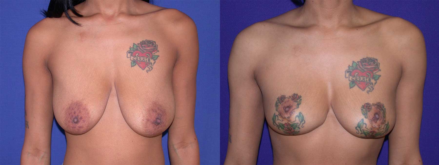 Before and After Image of Breast Lift Mastoplexy