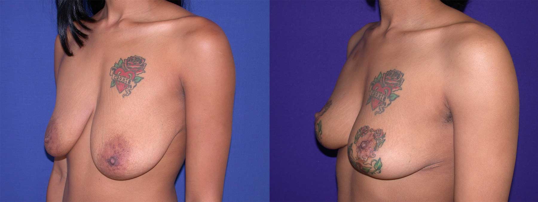 Before and After Image of Breast Lift Mastoplexy