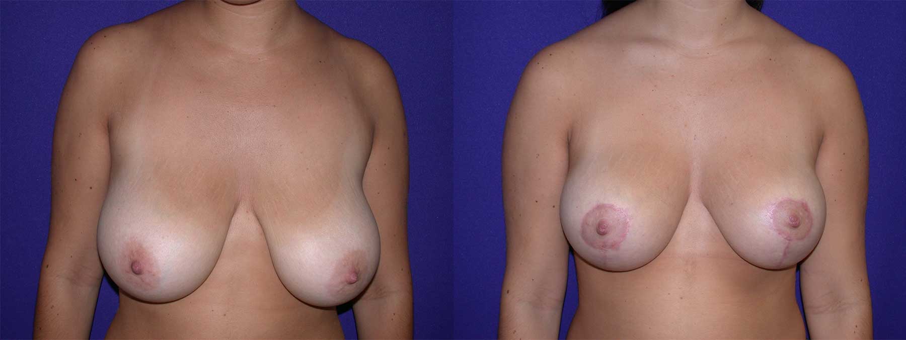 Before and After Image of Breast Lift Mastoplexy