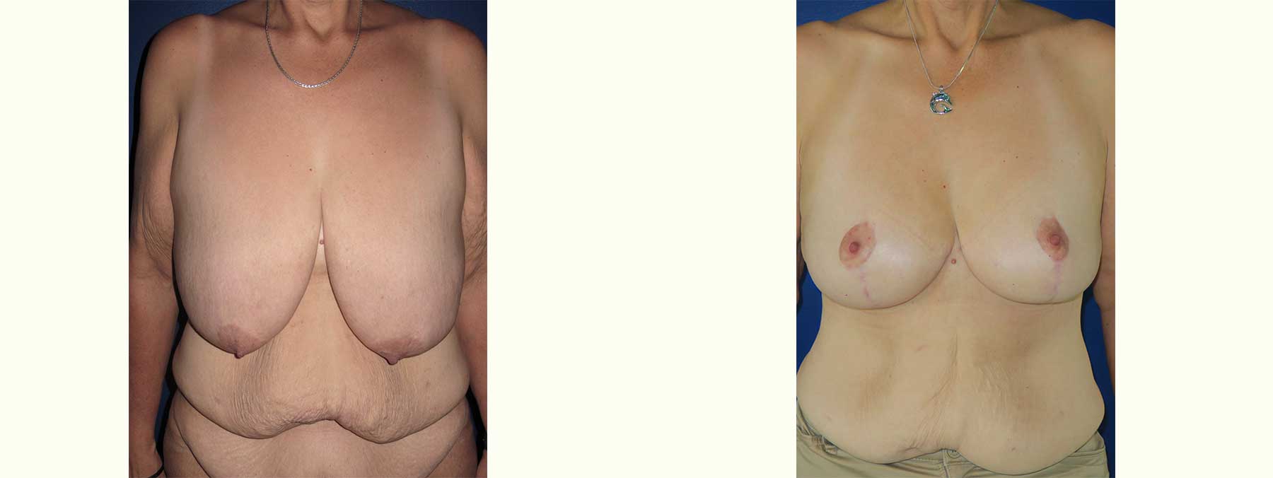 Before and After Image of Breast Lift Mastoplexy