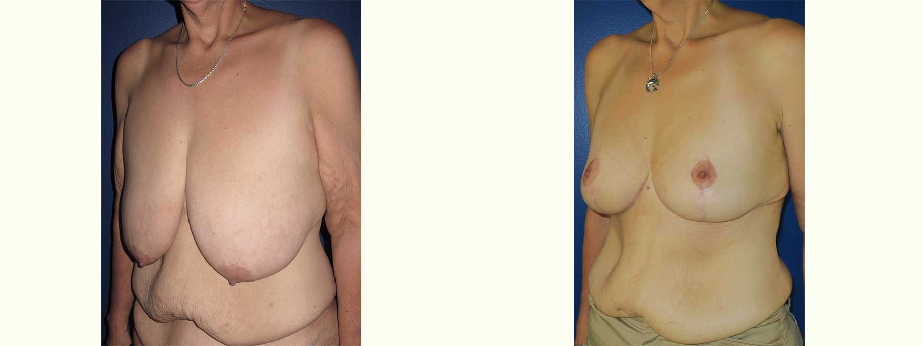 Before and After Image of Breast Lift Mastoplexy