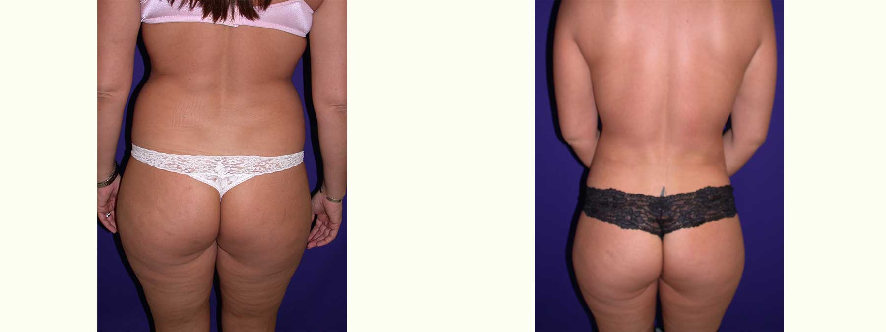 Before and After Image of Liposuction