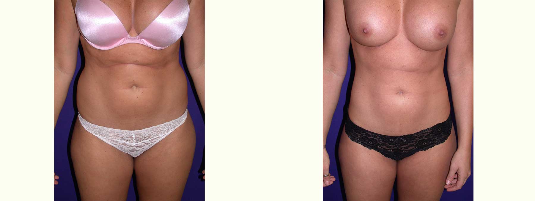 Before and After Image of Liposuction