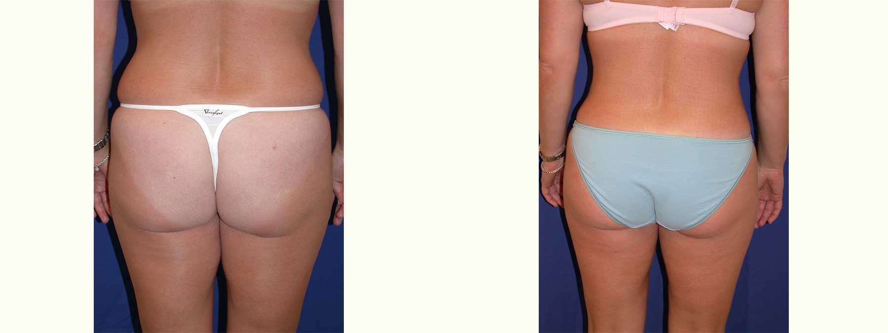 Before and After Image of Liposuction