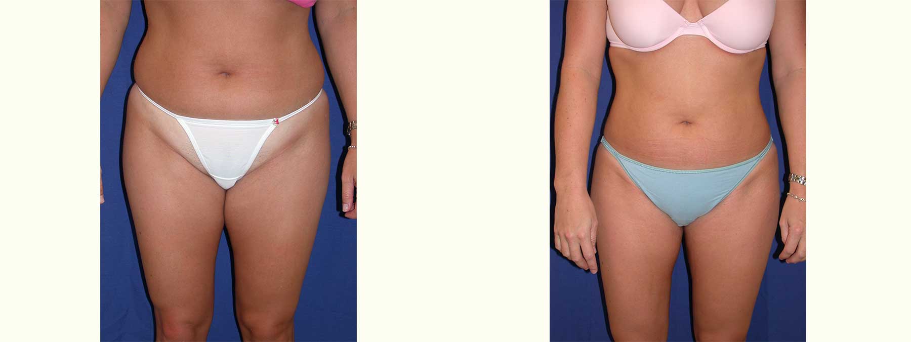 Before and After Image of Liposuction