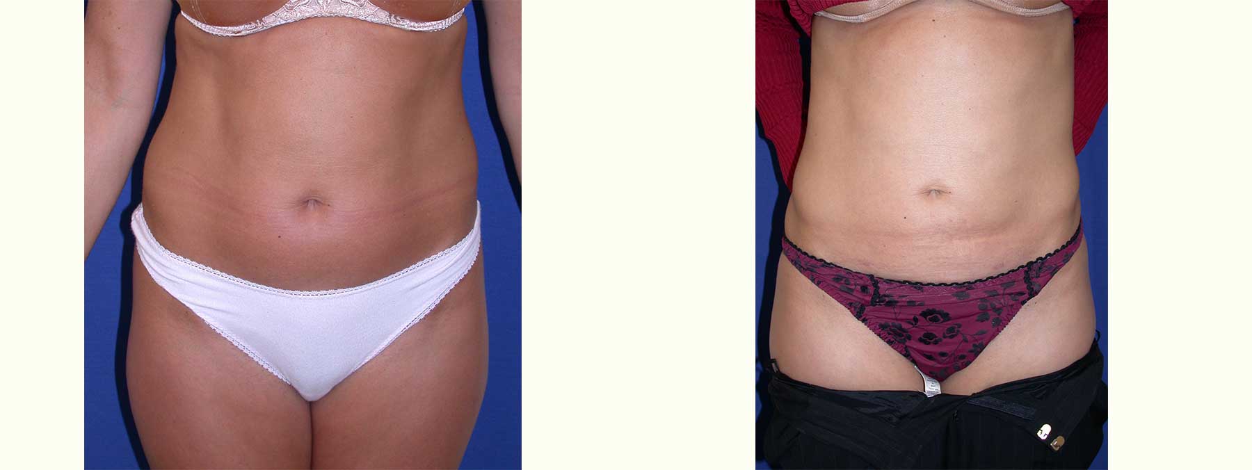 Before and After Image of Liposuction