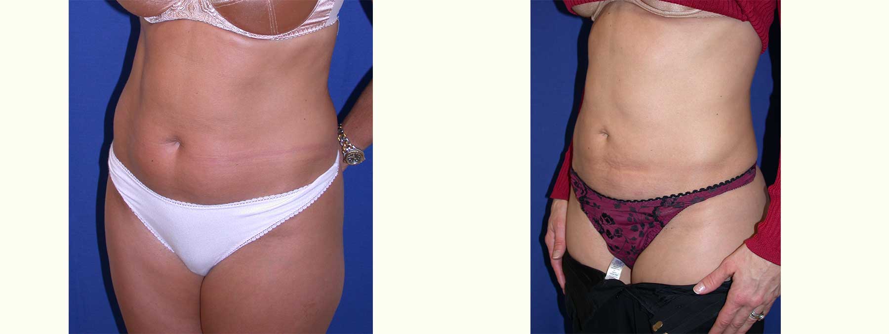 Before and After Image of Liposuction