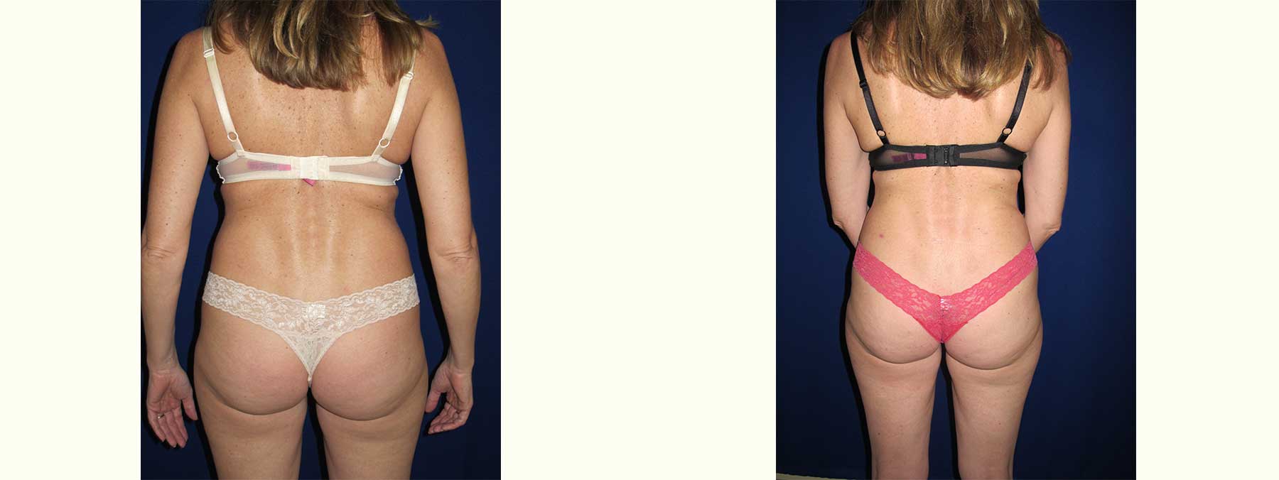 Before and After Image of Liposuction