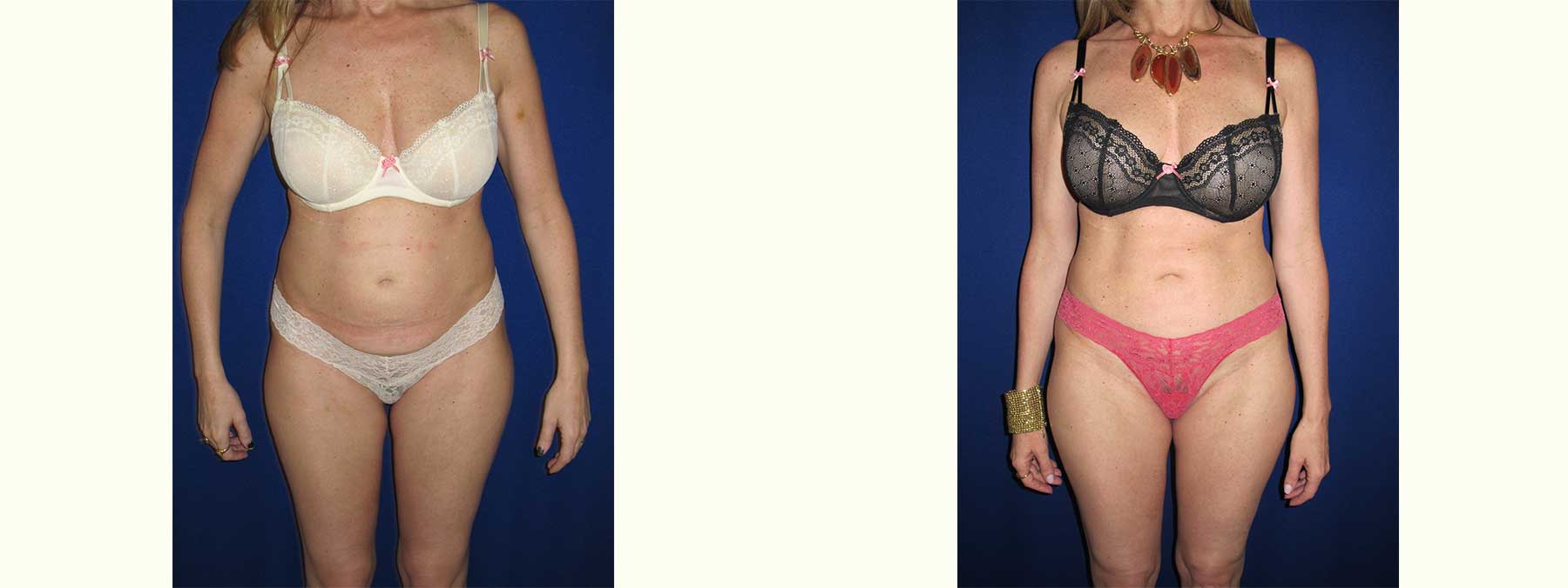 Before and After Image of Liposuction