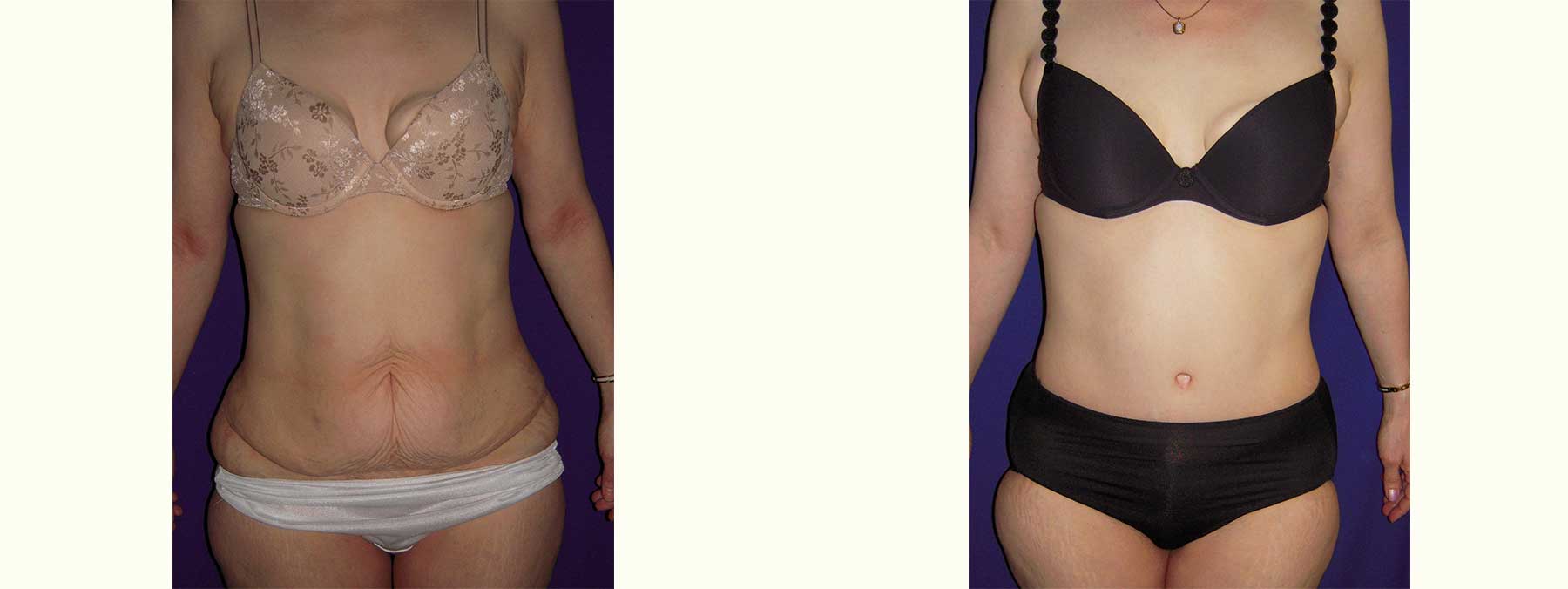 Before and After Image of Abdominoplasty