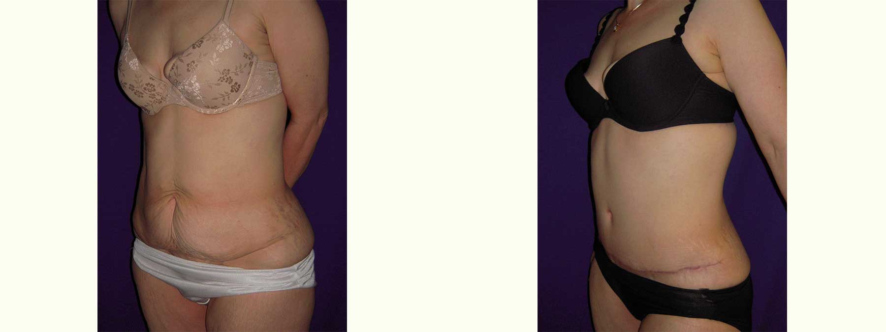 Before and After Image of Abdominoplasty