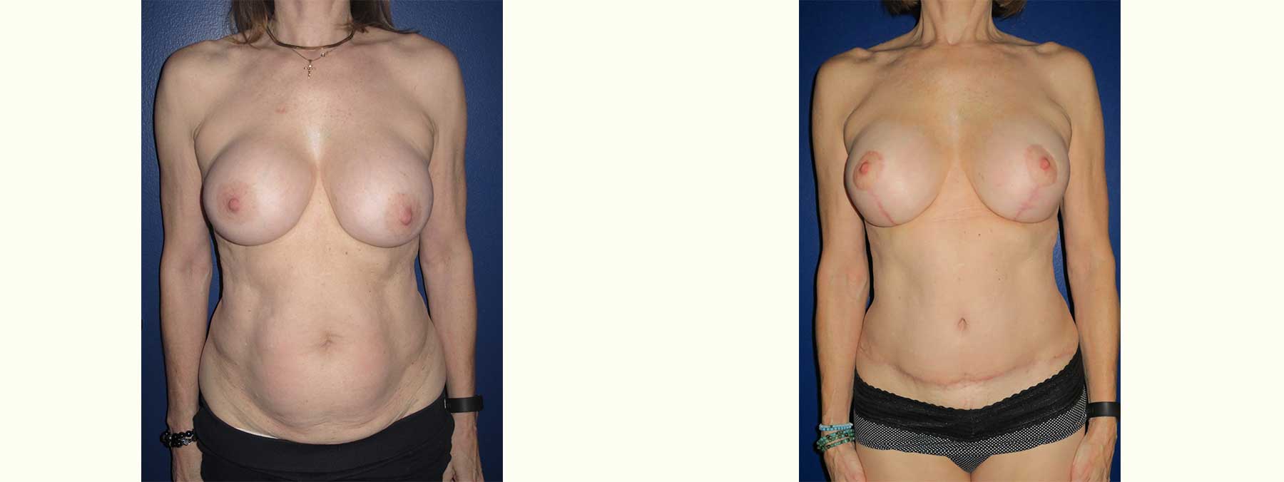 Before and After Image of Abdominoplasty