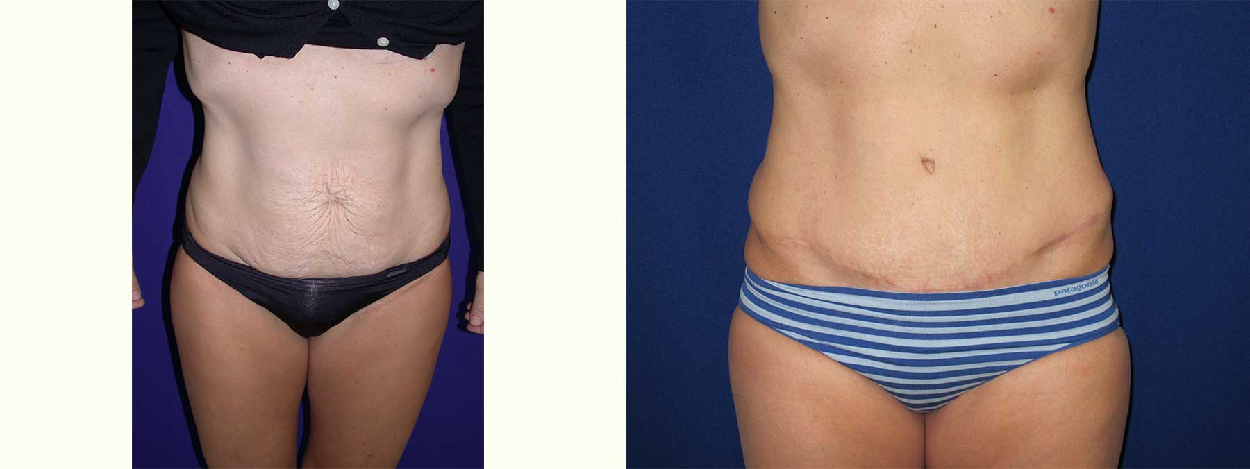 Before and After Image of Abdominoplasty