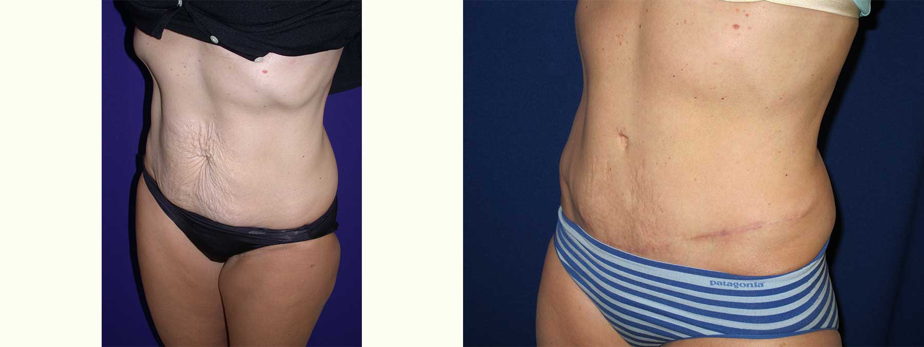 Before and After Image of Abdominoplasty