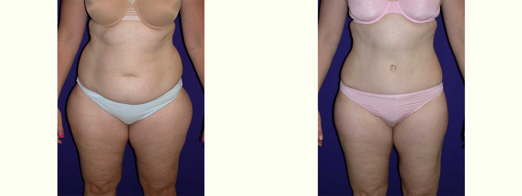 Before and After Image of Abdominoplasty