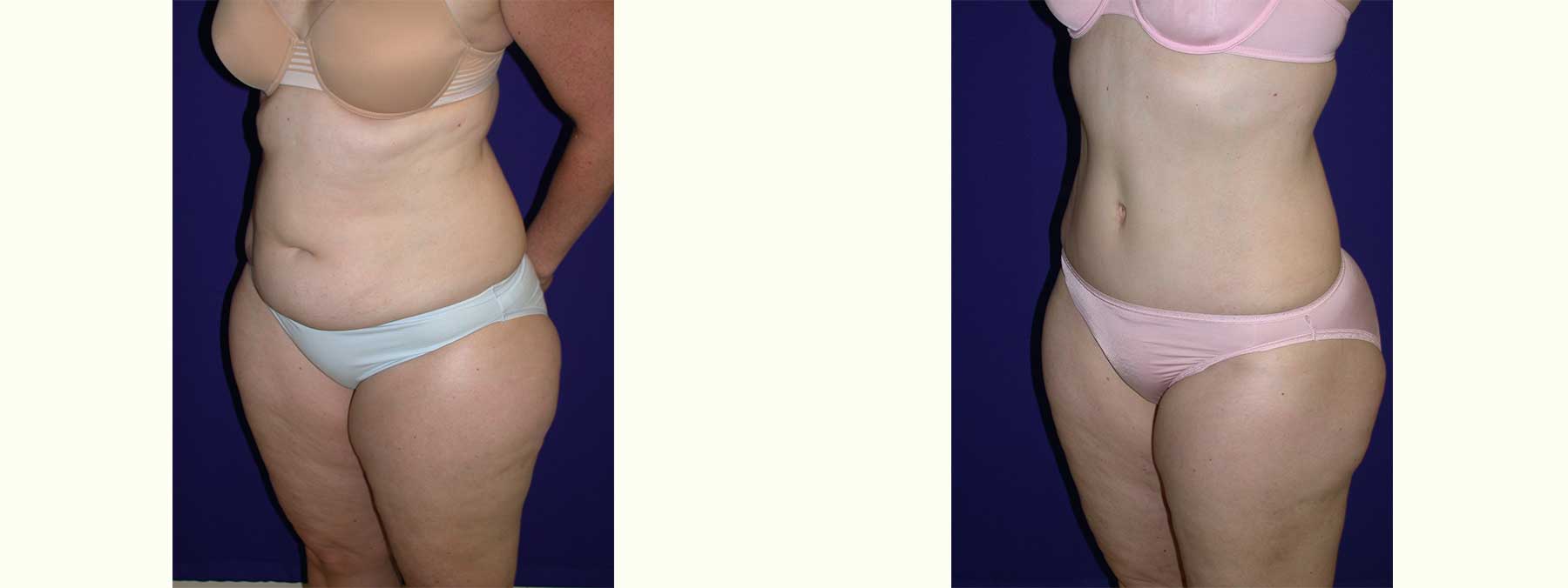 Before and After Image of Abdominoplasty