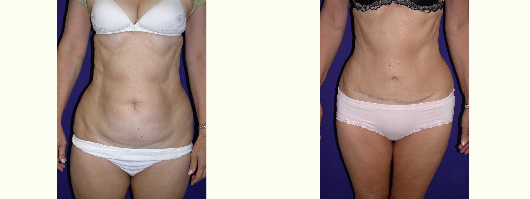 Before and After Image of Abdominoplasty