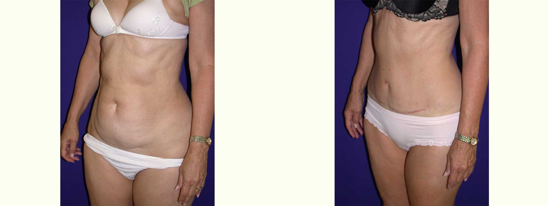 Before and After Image of Abdominoplasty