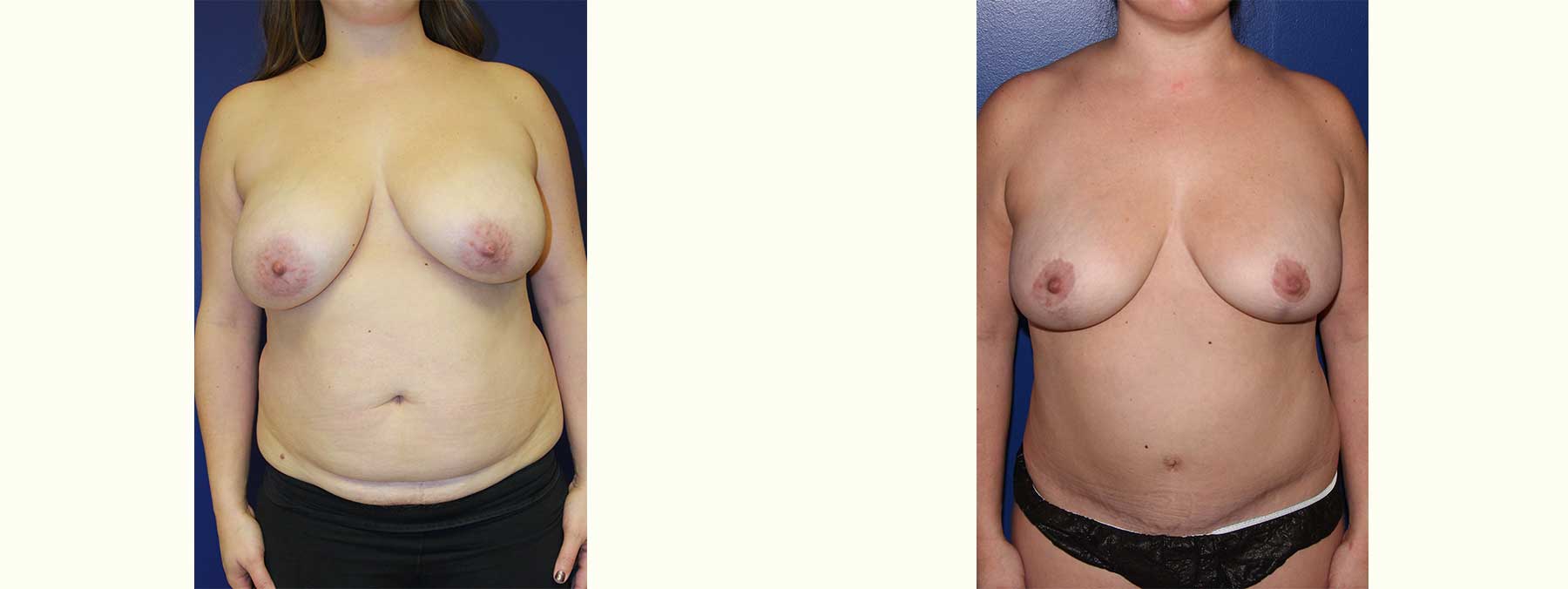 Before and After Image of Abdominoplasty
