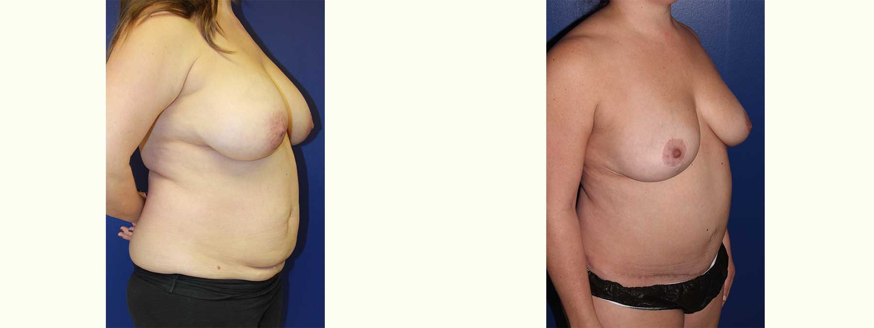 Before and After Image of Abdominoplasty