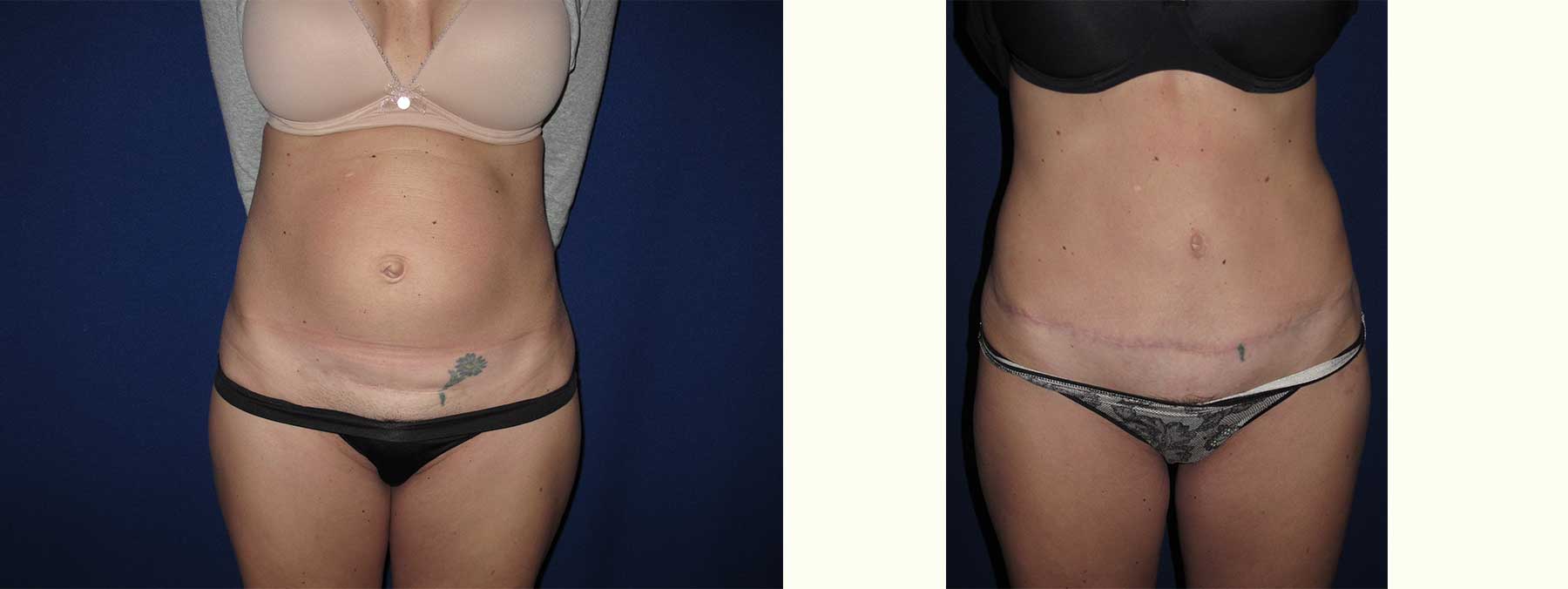 Before and After Image of Abdominoplasty