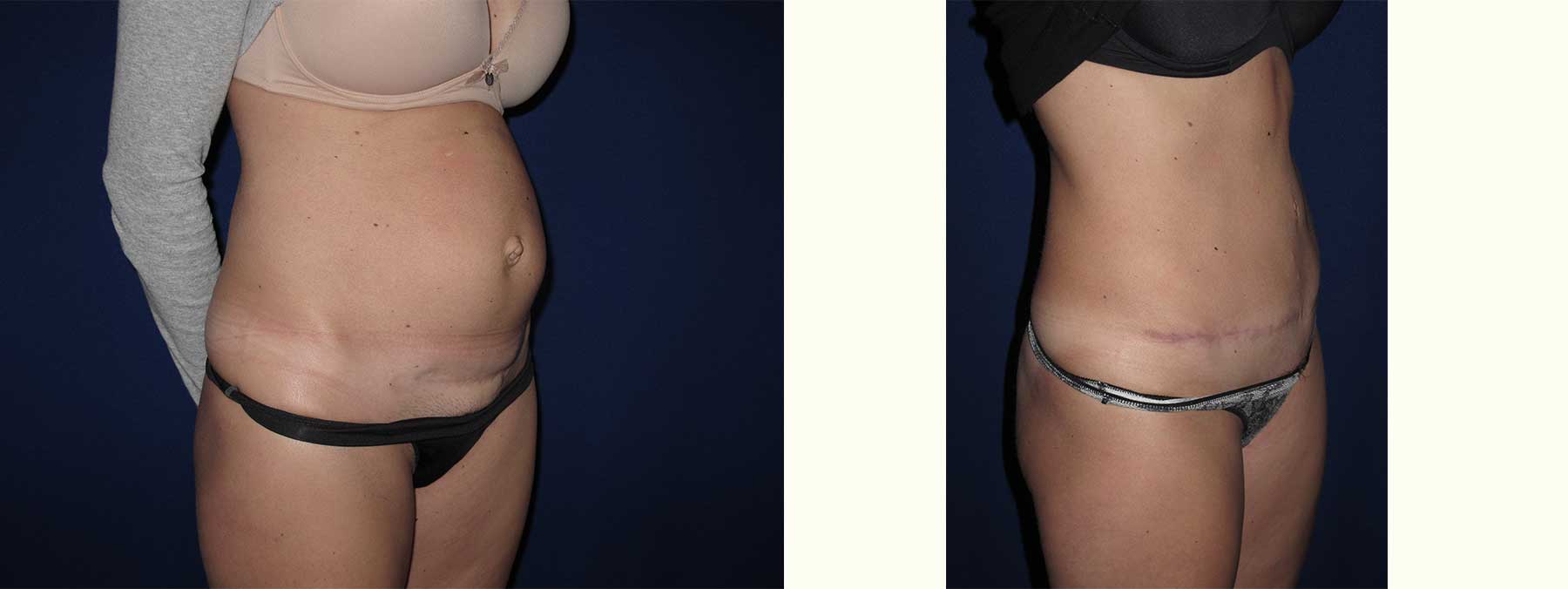 Before and After Image of Abdominoplasty