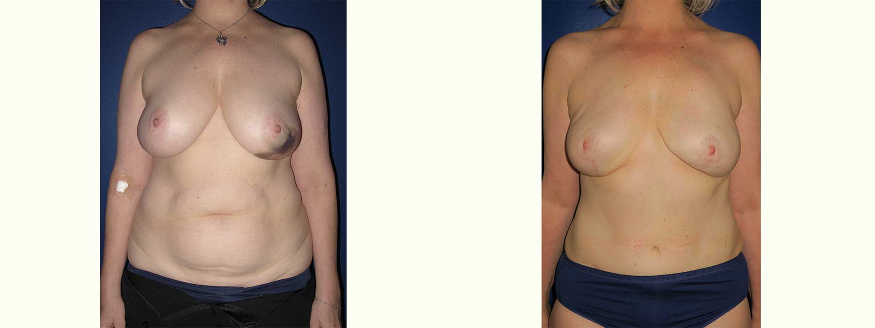 Before and After Image of Diep Flap Breast Reconstruction