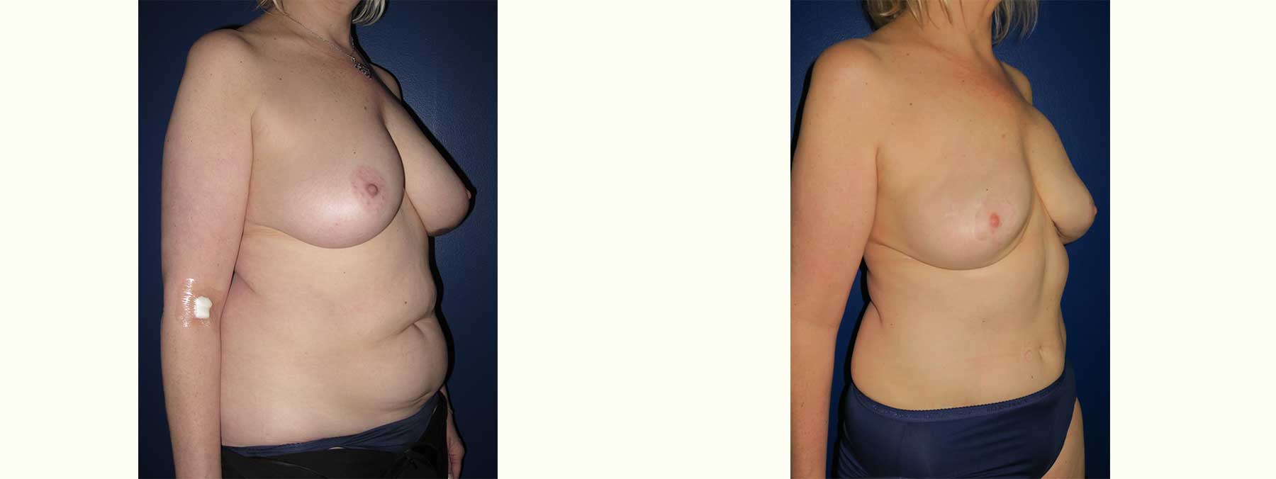 Before and After Image of Diep Flap Breast Reconstruction