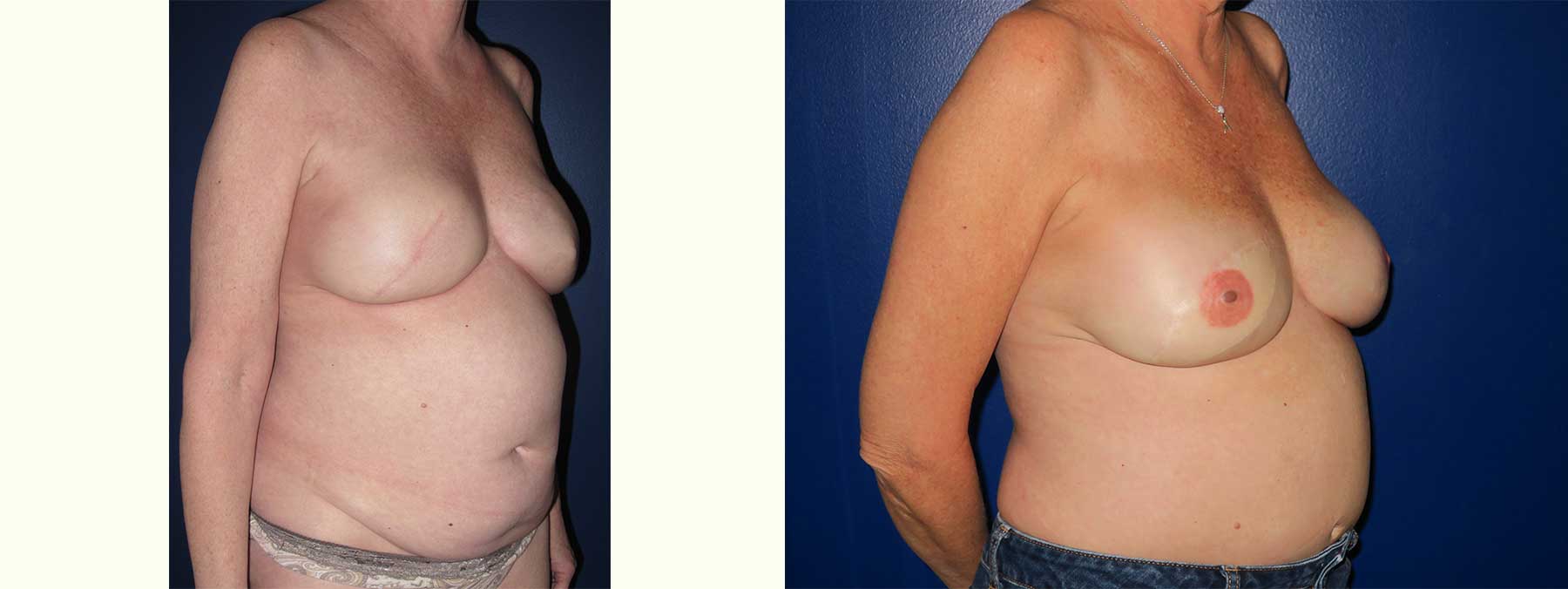 Before and After Image of Diep Flap Breast Reconstruction