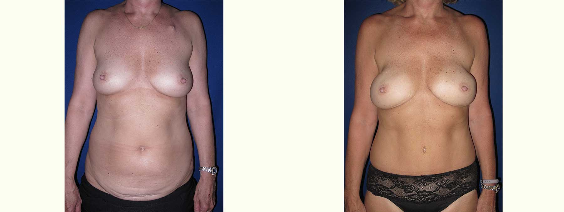 Before and After Image of Diep Flap Breast Reconstruction