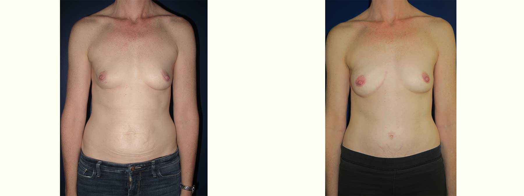 Before and After Image of Diep Flap Breast Reconstruction