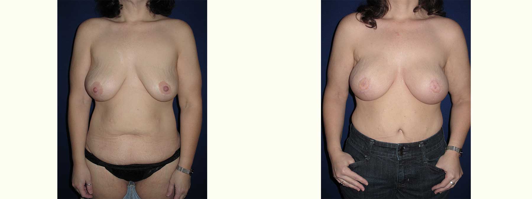 Before and After Image of Diep Flap Breast Reconstruction