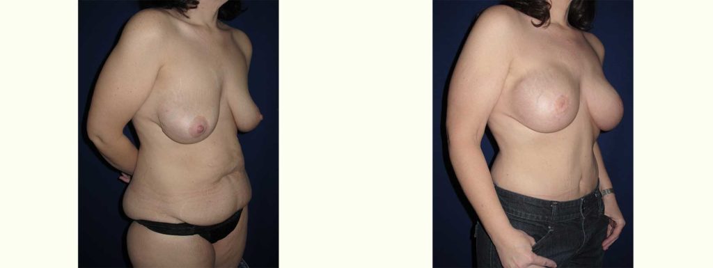 Before and After Image of Diep Flap Breast Reconstruction