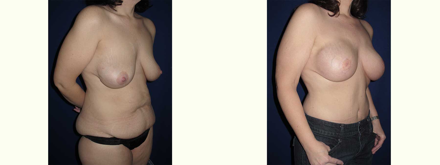 Before and After Image of Diep Flap Breast Reconstruction