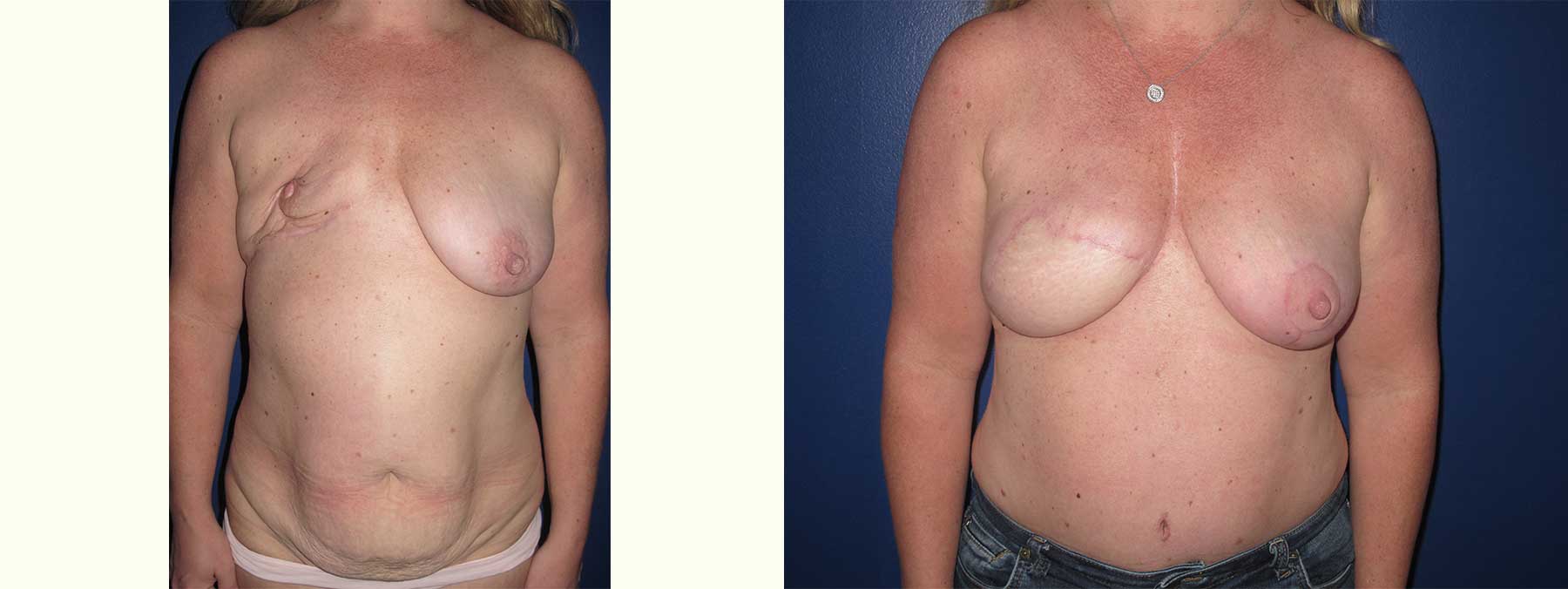 Before and After Image of Diep Flap Breast Reconstruction